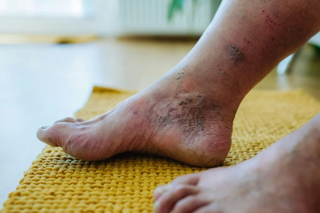 Close-up of a foot and ankle with skin discoloration and swelling