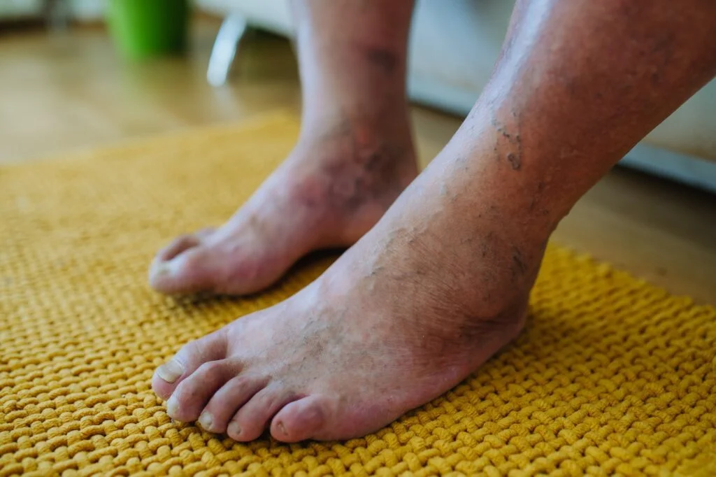 Close-up of swollen feet and ankles.