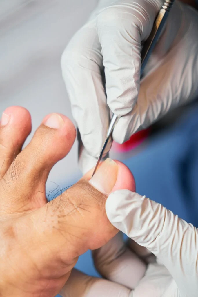 Healthcare professional treating an ingrown toenail