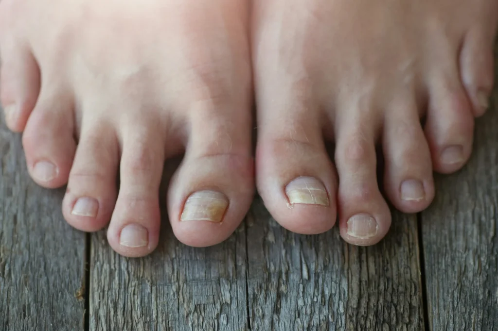 Close-up of two feet showing toenails with onycholysis and yellowing discoloration